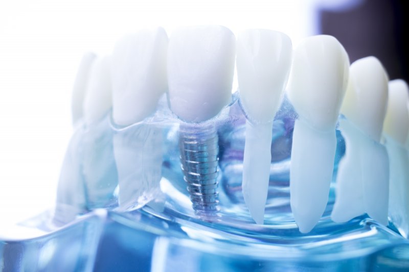 Complex Dental Implants in Towson | Melody D. Ward DDS